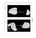 Fig. 08 - Smooth rollover insole for prosthetic foot