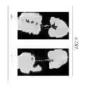 Fig. 10 - Smooth rollover insole for prosthetic foot