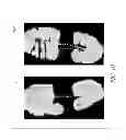 Fig. 11 - Smooth rollover insole for prosthetic foot