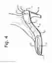 Fig. 04 - Removable shoe insert for corrective sizing