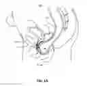 Fig. 02 - Rectocele and cystocele device