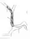Fig. 197 - Methods of cutting tubular devices