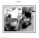 Fig. 07 - Cannulas, Collars for Implantable Devices, and Corresponding Systems and Methods