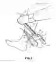 Fig. 06 - Long handled sock donning tool and method of use