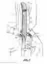 Fig. 07 - Long handled sock donning tool and method of use