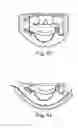 Fig. 22 - Head mounted display assembly with structural frame and separate outer frame