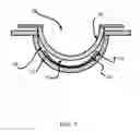 Fig. 02 - Ophthalmic lenses with colorant patterned inserts