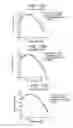 Fig. 16 - Presbyopia lens with pupil size correction based on level of refractive error