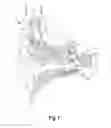 Fig. 02 - Transitioning operating modes in a medical prosthesis