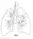 Fig. 02 - Methods and devices for lung volume reduction with extracellular matrix material