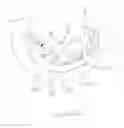Fig. 02 - Dental surgical implant guide and prosthesis combination and method of use