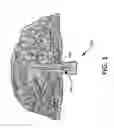Fig. 02 - ROOT CANAL FOR TISSUE IN-GROWTH