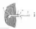 Fig. 07 - ROOT CANAL FOR TISSUE IN-GROWTH