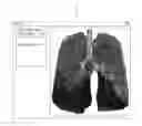 Fig. 01 - TREATMENT PLANNING FOR LUNG VOLUME REDUCTION PROCEDURES