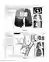 Fig. 06 - TREATMENT PLANNING FOR LUNG VOLUME REDUCTION PROCEDURES