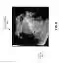 Fig. 07 - Systems and Methods to Detect and Present Interventional Devices via Ultrasound Imaging