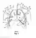 Fig. 02 - MINIMALLY INVASIVE METHODS AND APPARATUS