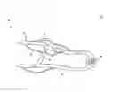 Fig. 02 - Devices, Systems, and Methods for Preservation of Arteriovenous Access Sites