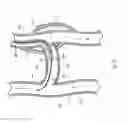 Fig. 22 - Devices, Systems, and Methods for Preservation of Arteriovenous Access Sites