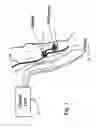 Fig. 02 - Wireless footswitch and functional electrical stimulation apparatus