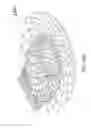 Fig. 45 - Intragastric device for treating obesity