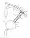 Fig. 01 - Devices, systems and methods for diverting fluid trapped in a solid organ