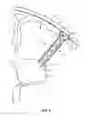 Fig. 02 - Devices, systems and methods for diverting fluid trapped in a solid organ