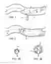 Fig. 02 - Expandable member for perforation occlusion