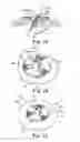 Fig. 15 - Socketed portal anchors and methods of using same