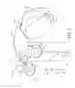 Fig. 02 - Stepped catheters with flow restrictors and infusion systems using the same