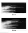Fig. 07 - Method of treating infections, diseases or disorders of nail unit