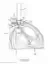 Fig. 22 - Method and apparatus for placing a cannula in a bladder
