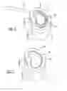 Fig. 04 - PERCUTANEOUS INTERVERTEBRAL ANNULAR REGENERATION
