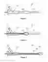 Fig. 02 - Elastic Catheter