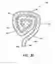 Fig. 07 - Intrauterine treatment device with articulating array
