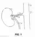 Fig. 02 - Mediguide-enabled renal denervation system for ensuring wall contact and mapping lesion locations