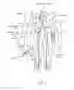 Fig. 03 - Helical push wire electrode