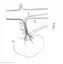 Fig. 05 - Catheter adapted for use with guide wire for accessing vessels