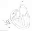 Fig. 01 - CATHETER SYSTEM
