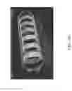 Fig. 35 - Methods and apparatuses for remodeling tissue of or adjacent to a body passage