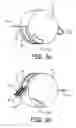 Fig. 04 - HANDPIECE FOR AN ABLATION DEVICE HAVING TOOL PIECE WITH MULTIPLE ORIENTATIONS AND METHOD FOR RECONFIGURING HANDPIECE