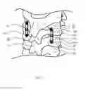 Fig. 02 - Spine Fixation Device and Method