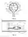 Fig. 04 - Resection device with support mechanism and related methods of use