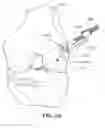 Fig. 35 - Retro guidewire reamer