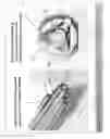 Fig. 09 - SYSTEMS AND METHODS FOR IMPLANTING BONE GRAFT AND IMPLANT