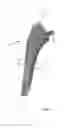 Fig. 02 - Bone broach and method of manufacturing a bone broach