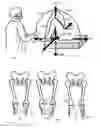 Fig. 02 - System and method for assessing, measuring, and correcting an anterior-posterior bone cut