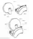 Fig. 22 - Bone cutting system for the leg and method therefor