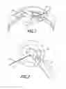 Fig. 02 - Intraocular lens inserters