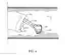 Fig. 04 - Resection device with support mechanism and related methods of use